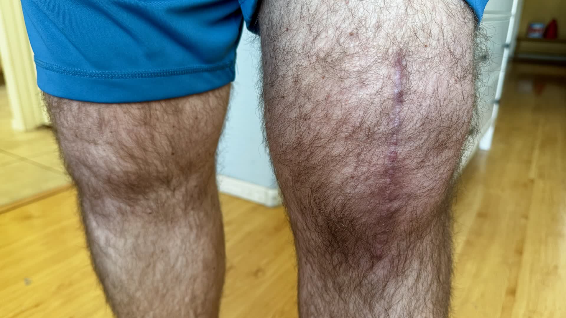 Four months after total knee replacement surgery. Yes, the hairs have grown back nicely.